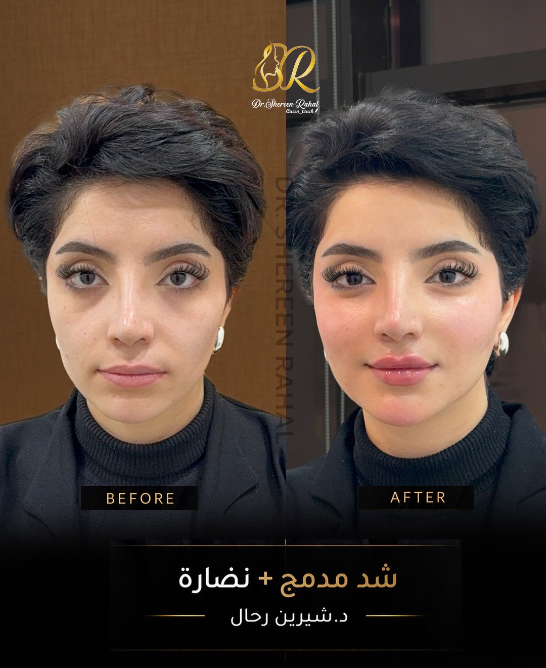مقارنة قبل وبعد — شد مدمج ونضارة