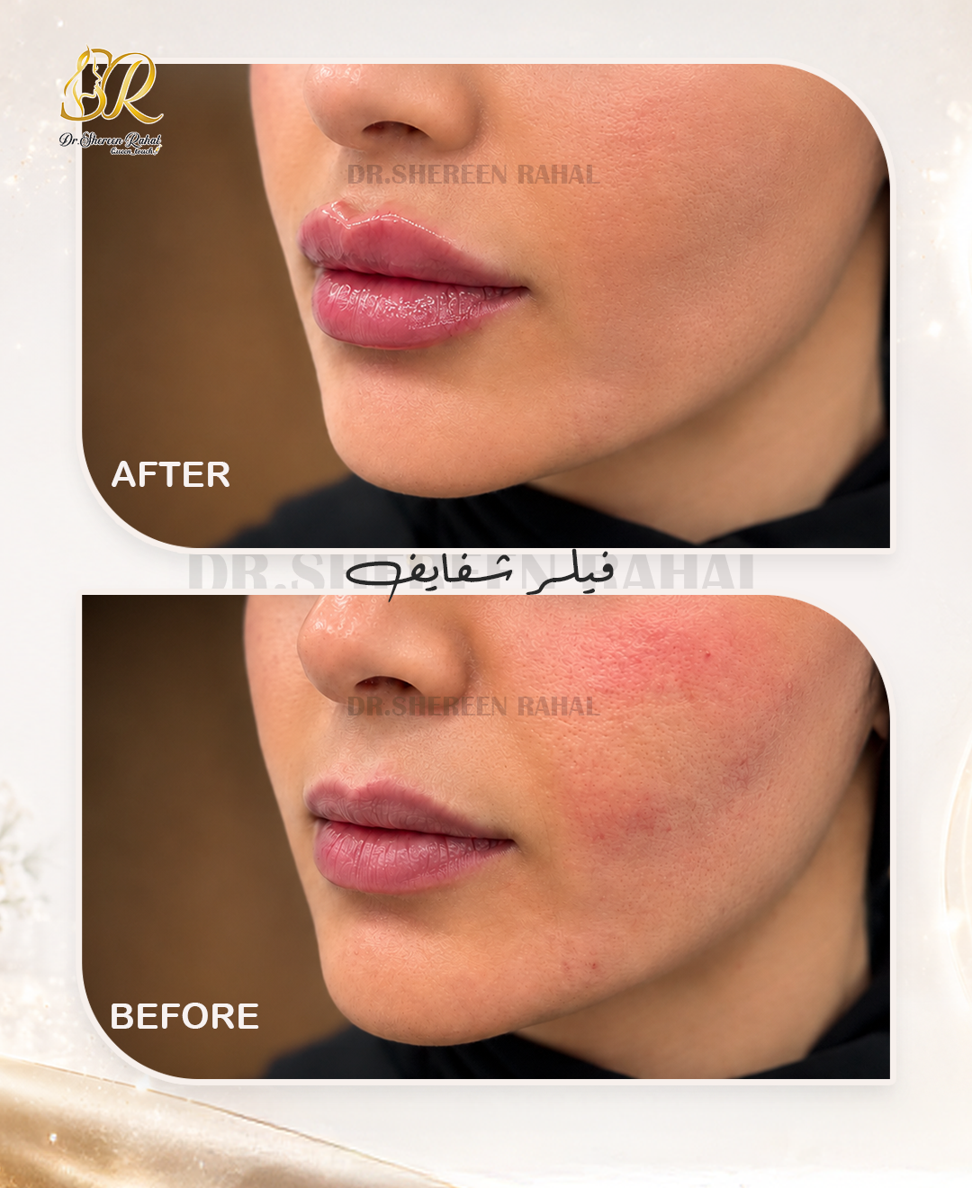 مقارنة قبل وبعد — تجميل الشفاه